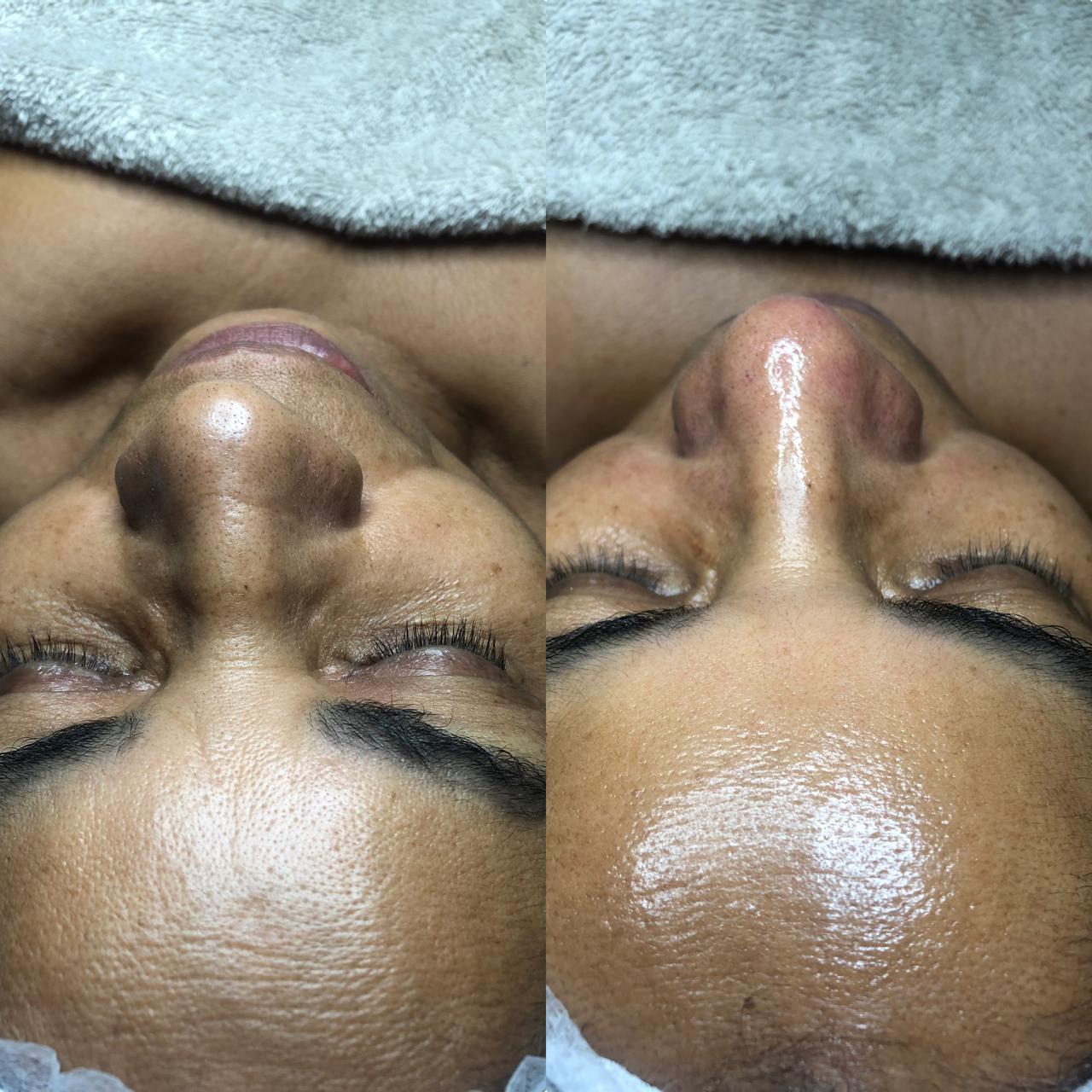 Antes e depois — redução de poros e oleosidade em uma sessão
