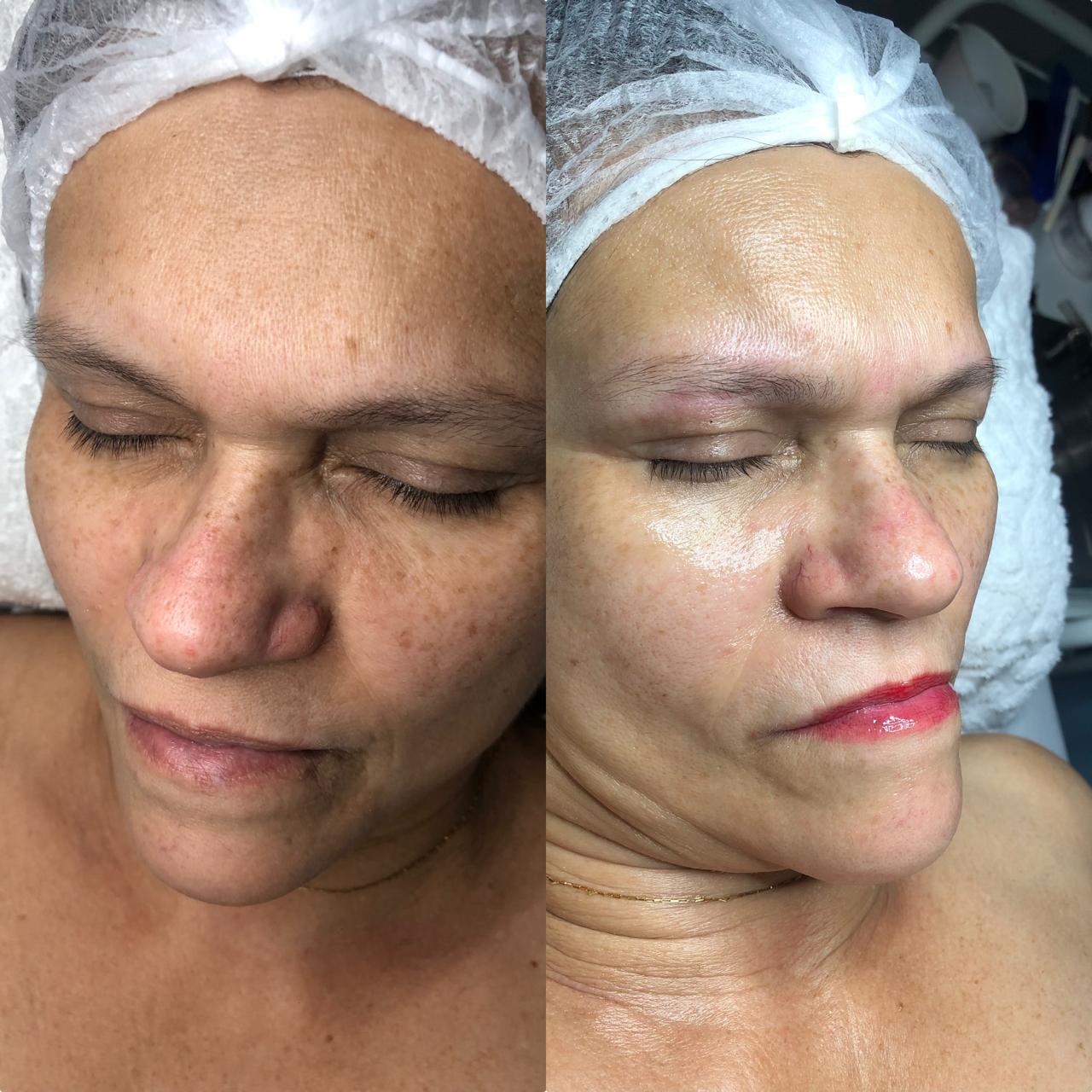 Antes e depois — melhora de manchas e textura da pele em uma sessão