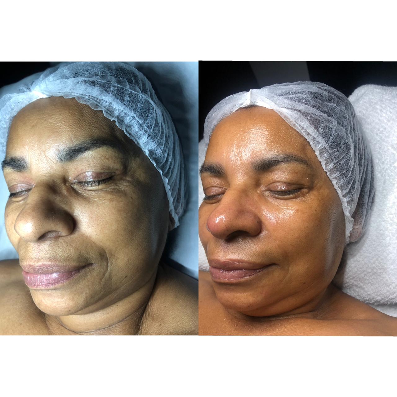 Antes e depois — hidratação e luminosidade em uma sessão